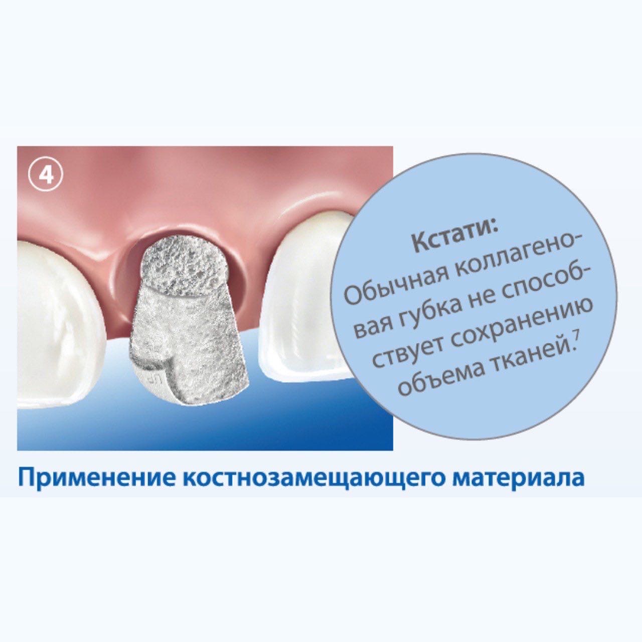 Методика сохранения альвеолярного гребня